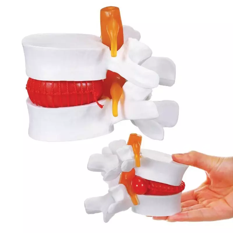 modelscart-herniated-lumbar-vertebrae-disc-prolapse-model-made-of-pvc-plastic-for-medical-education-training-rx-1120