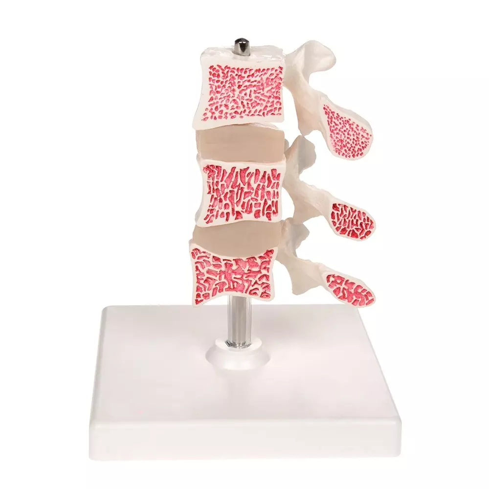 MODELSCART Cutaway Osteoporosis Model, Made of PVC Plastic, Stand Mounting for Medical Education & Training, XC-134