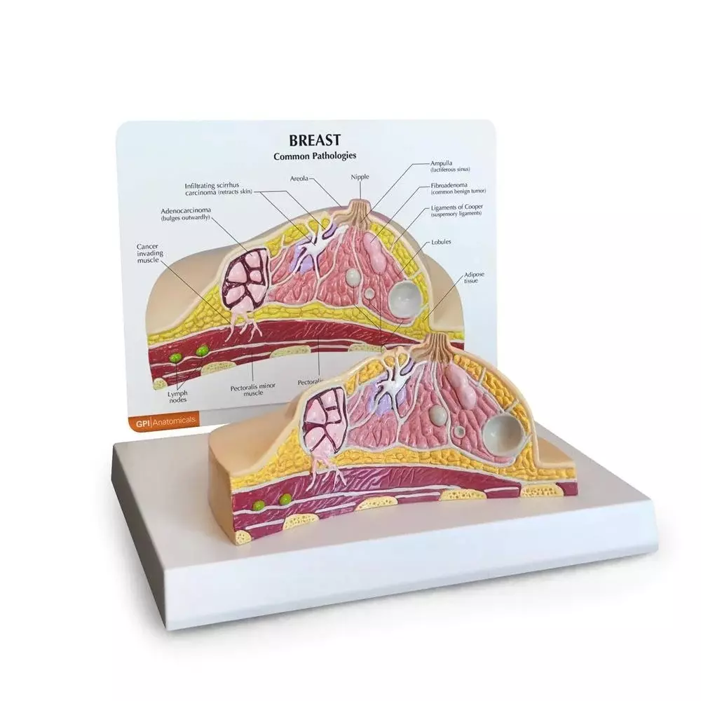 MODELSCART Breast Cross Section Model with Pathologies, Size 20 x 20 x 50 cm Made of PVC Plastic Mounted on Plastic Base for Medical Training, RX-418B