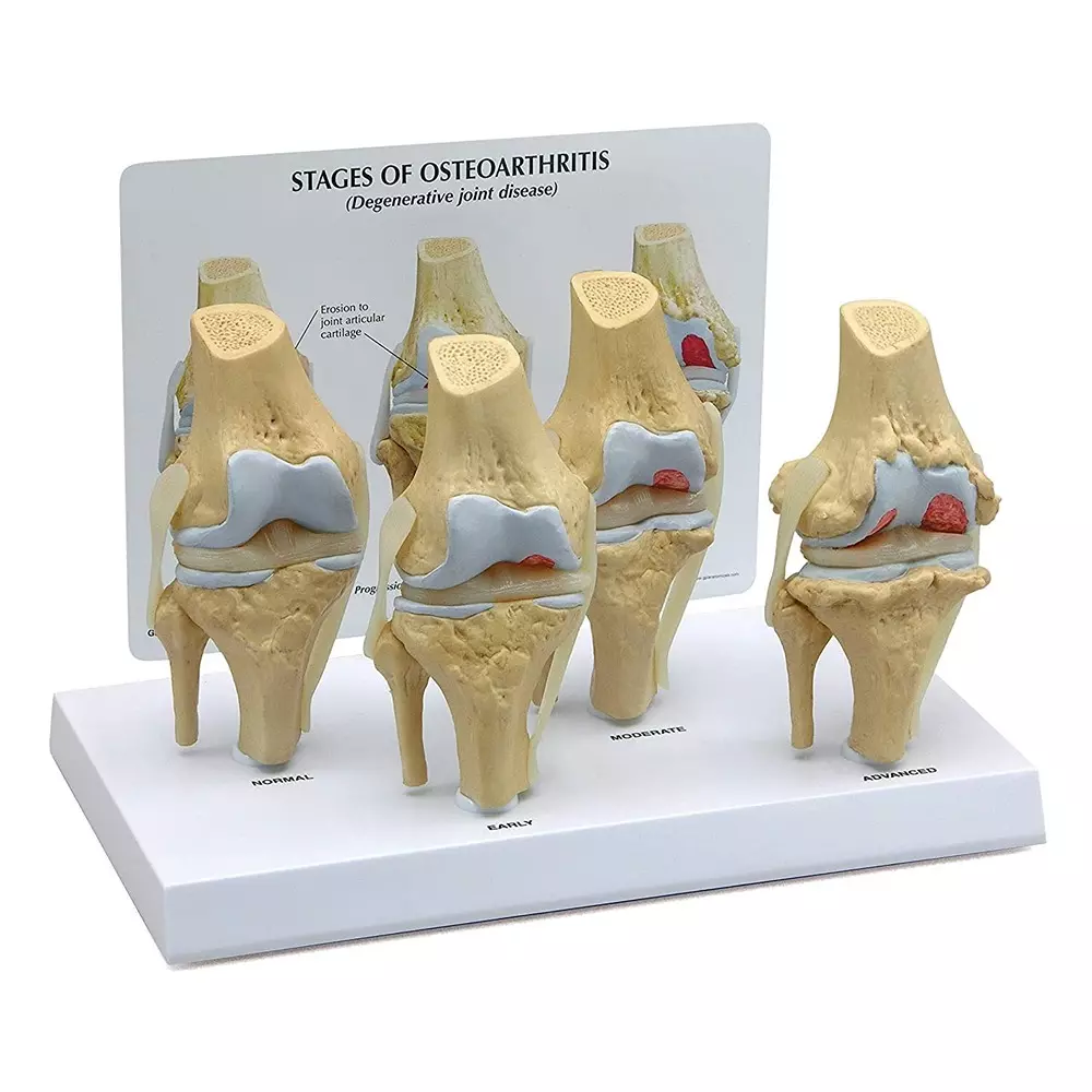 MODELSCART Knee Arthritis Model Osteoarthritis - Knee Disease Model, 3/4th of Natural Size Made of PVC Plastic Mounted on Display Stand, RX-1100