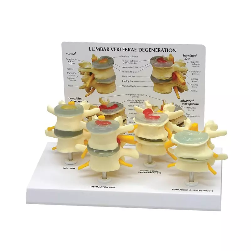 MODELSCART Vertebrae Degeneration Model, 3/4th of Natural Size Made of PVC Plastic, Display Stand Mounting for Medical Education, RX-1130