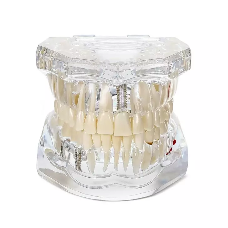 MODELSCART Transparent Dental Model with Pathologies, Cavities and Treatments, Life Size, Made of Acrylic for Medical Education & Training, RX-403T