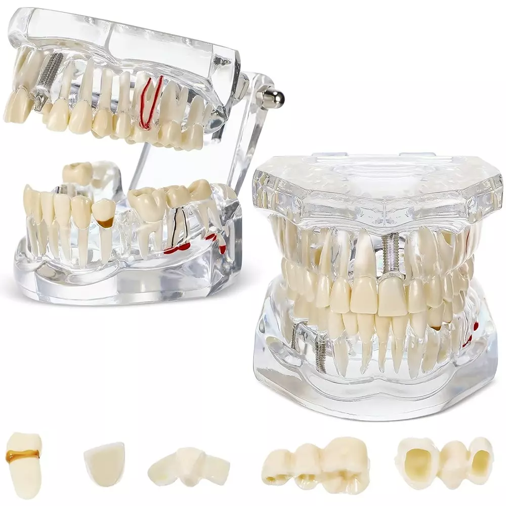 modelscart-transparent-dental-model-with-pathologies-cavities-and-treatments-life-size-made-of-acrylic-for-medical-education-training-rx-403t