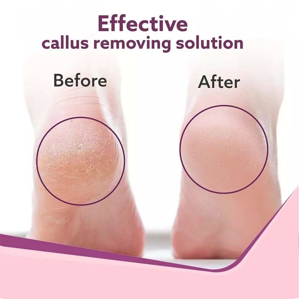 AGARO Callus Remover with 3 Interchangeable Head Rollers Pink For Removes Hard Skin, Cracked Heels, Rough Skin, and Dry Dead Skin, CR1727